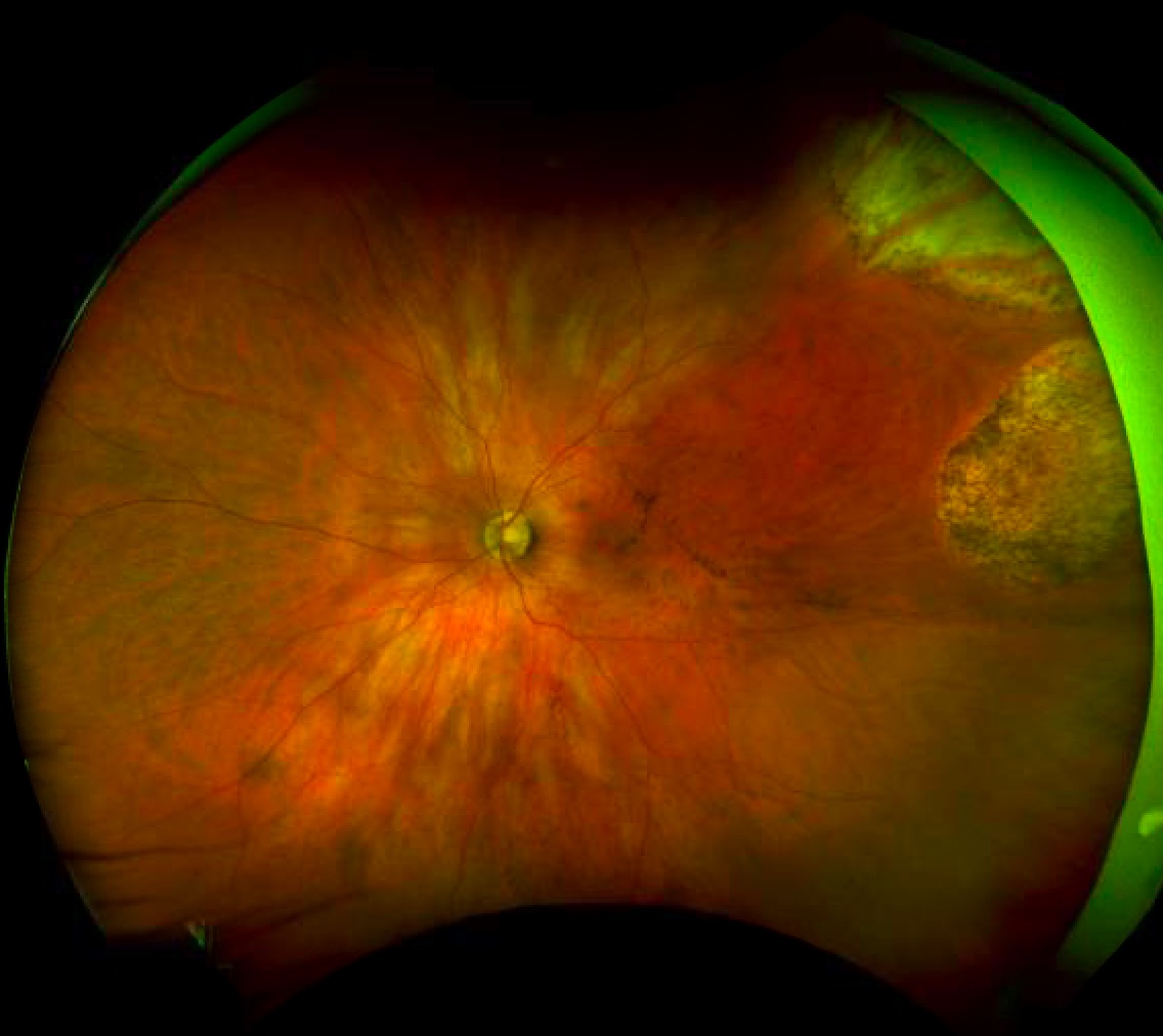 Retinal Detachment Diseases & Treatments RCPR